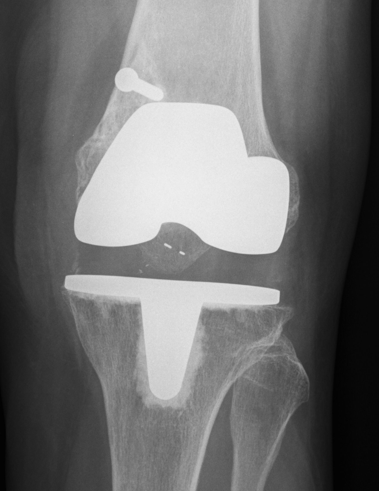 TKR Intraoperative condylar fracture